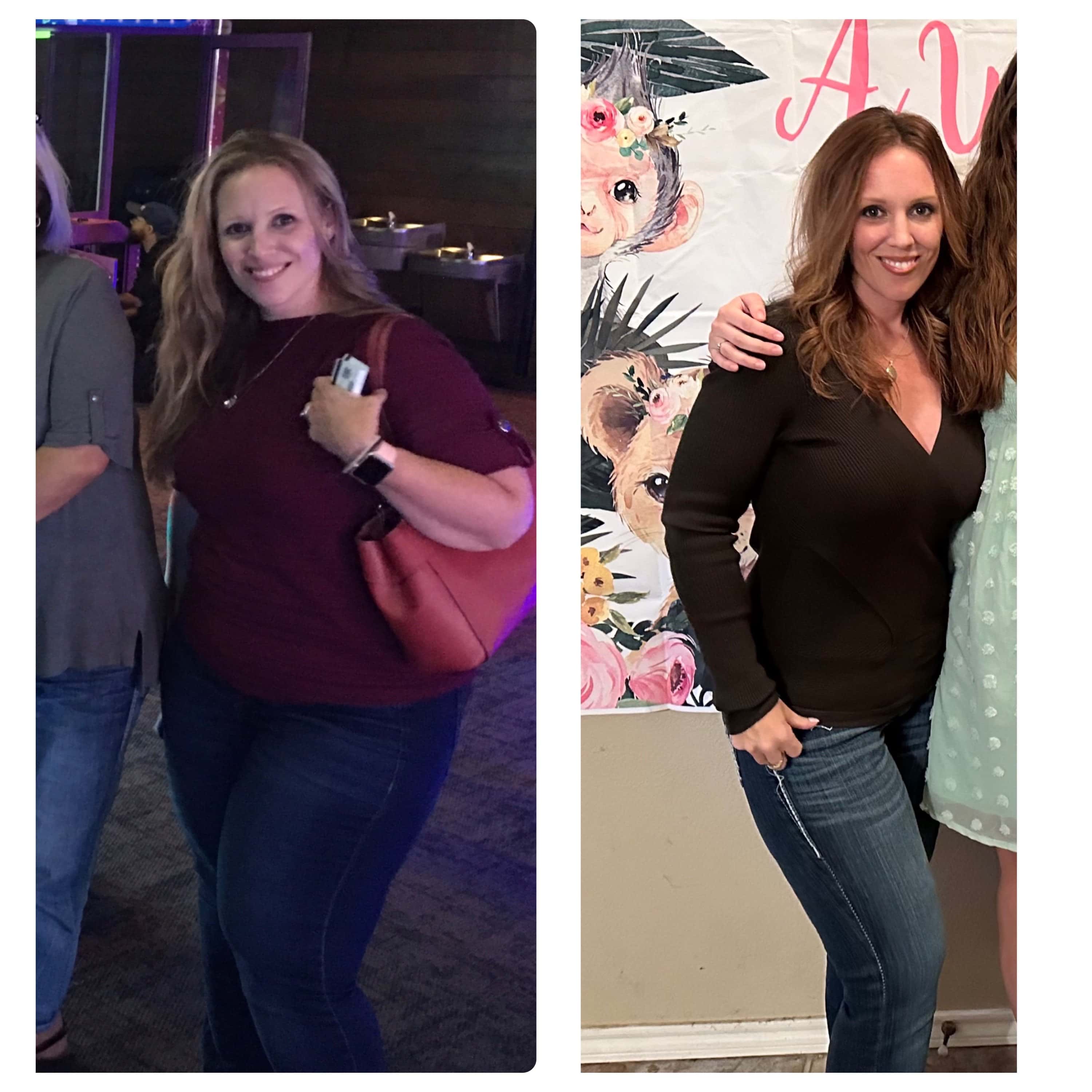 Weight Loss Surgery Gastric Sleeve before and after